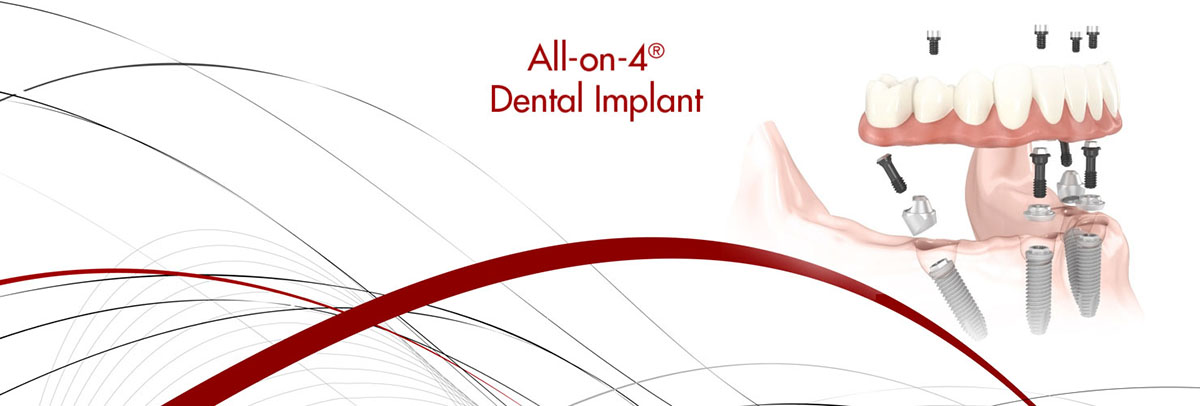 El Dorado Hills All-on-4 Dental Implants