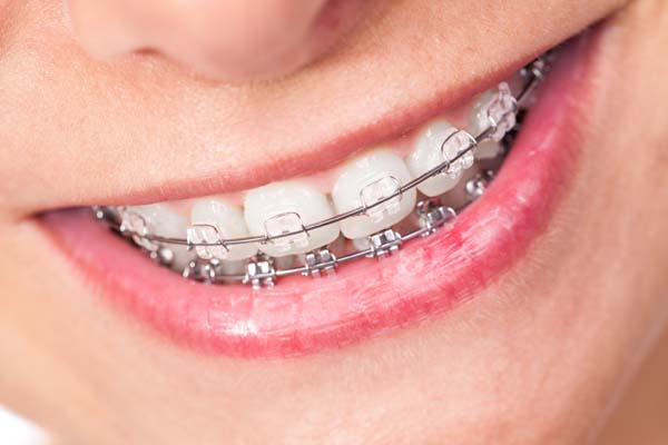 Clear Braces: What Are They?