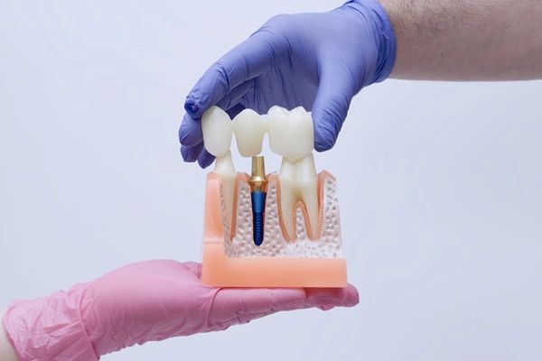 Dental Bridge Failure: What It Is And How To Avoid It