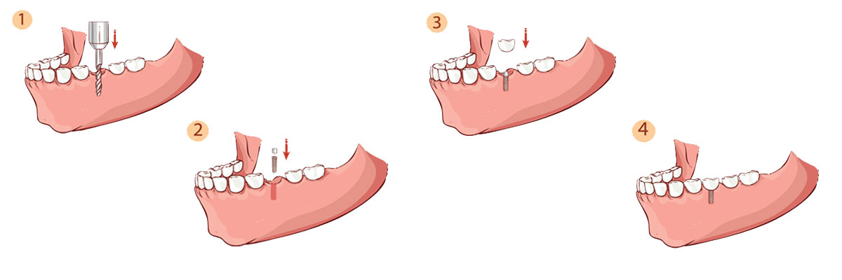 El Dorado Hills The Dental Implant Procedure