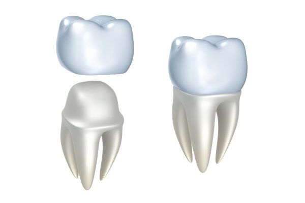 dental implants El Dorado Hills, CA