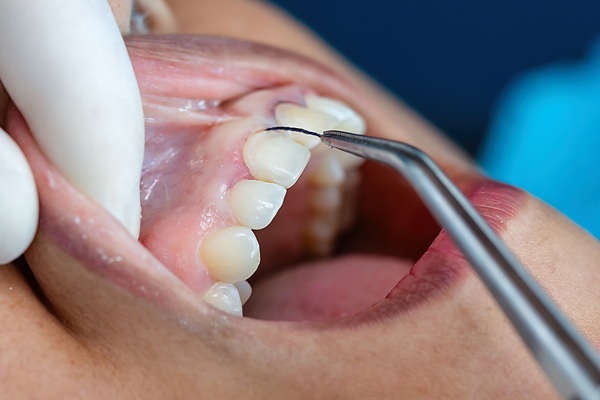 Silent And Dangerous: The Impact Of Gum Disease On Your Health