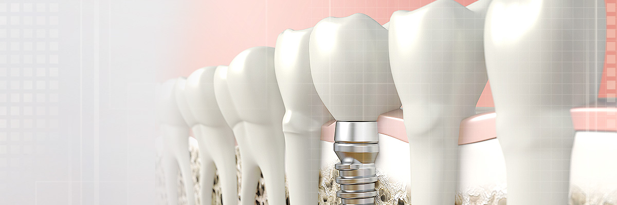 El Dorado Hills Implant Dentist