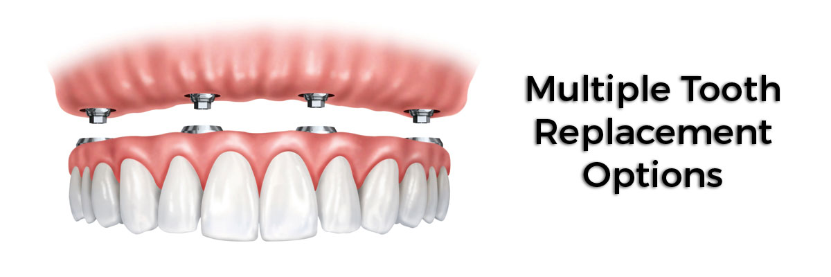 El Dorado Hills Multiple Teeth Replacement Options