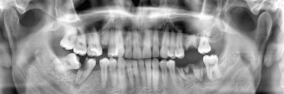 El Dorado Hills Options for Replacing Missing Teeth